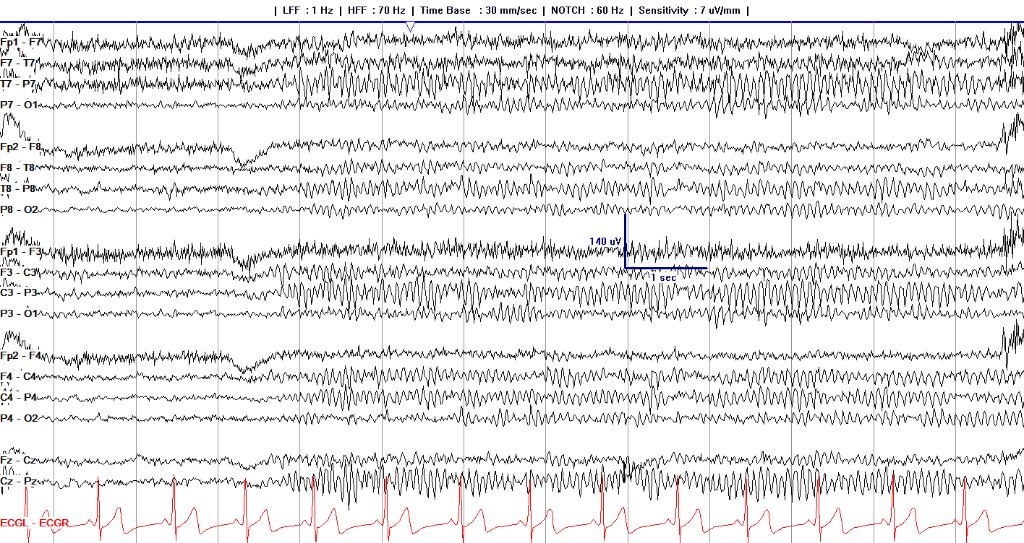 First half of an awake longitudinal bipolar page with a well-formed posterior dominant rhythm maximal at O1 and O2