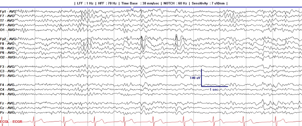 Full common-average referential EEG page, including electrode–average channel labels and recording settings