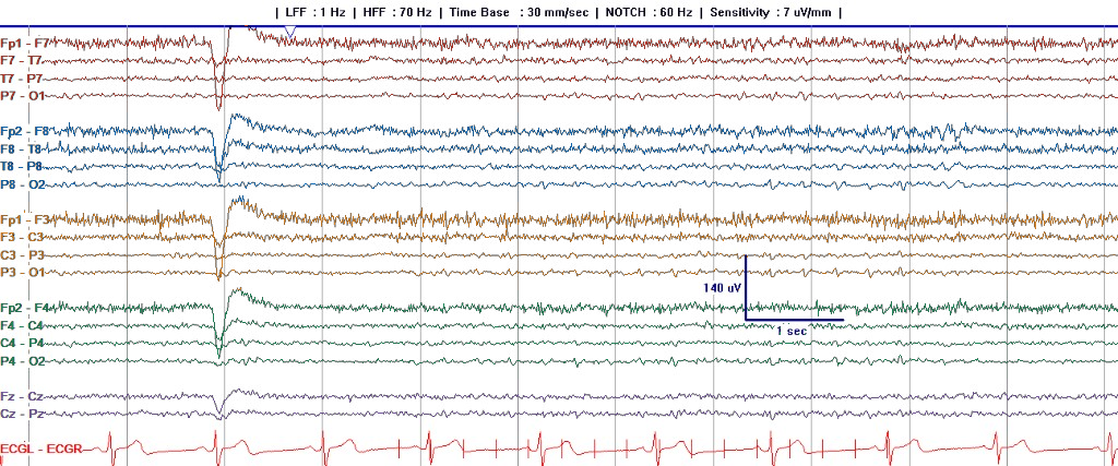 First half of a clinical longitudinal bipolar EEG page with left temporal, right temporal, left parasagittal, right parasagittal, and midline chains colored to match the map beside it