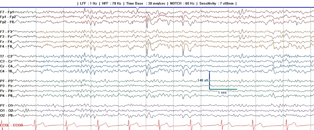 Full transverse bipolar EEG page with channel labels and colored left-to-right chains